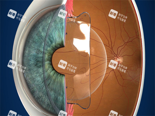 进行晶体植入的眼睛
