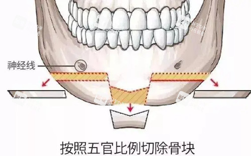 下颏T型截骨示意图