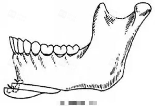 下颏截骨成型卡通示意图