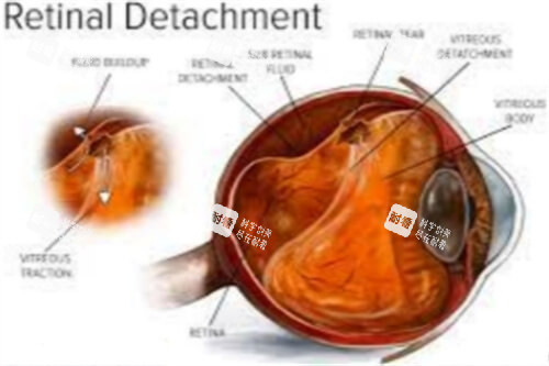 视网膜脱离示意图