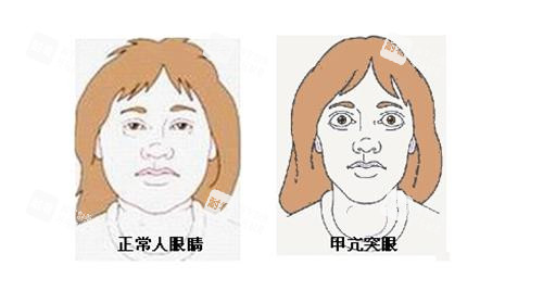 正常眼睛和突眼的对比
