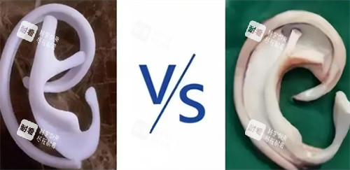 耳再造自体肋软骨和生物材料对比