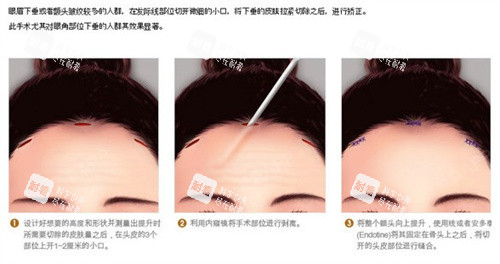 内窥镜提升额头适合人群
