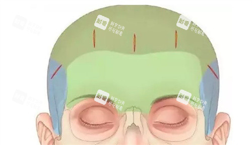 内窥镜额头提升手术切口