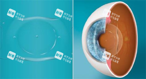 人工晶体植入眼睛的层次