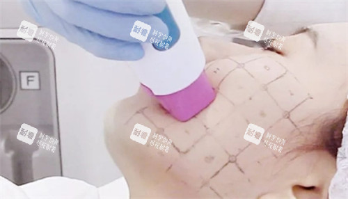 面部热玛吉治疗