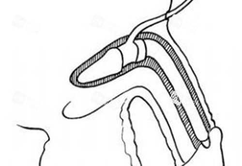 男性私密整形假体植入阴茎卡通示意图