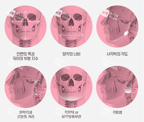 面部轮廓手术示意图