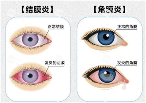 角膜炎和结膜炎的区别