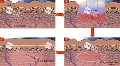 点阵激光作用于皮肤层次示意图