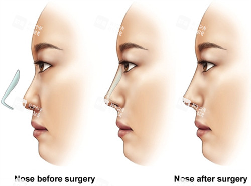 假体隆鼻手术前后对比