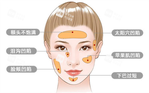 面部脂肪填充适应症
