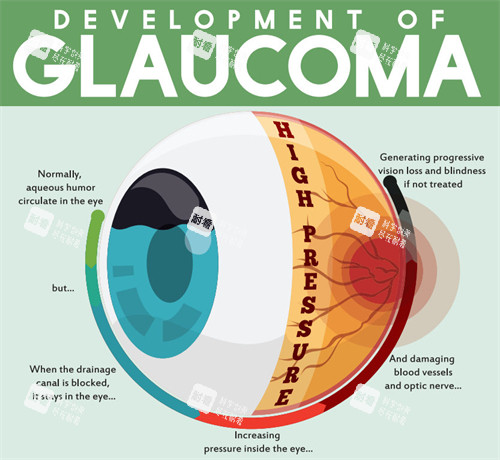 青光眼的眼睛结构图