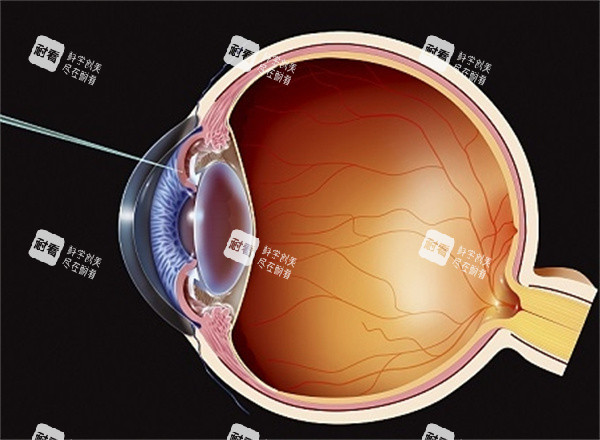 青光眼治疗插画图