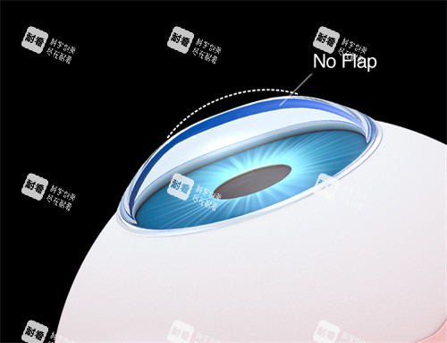 smart激光近视手术示意图