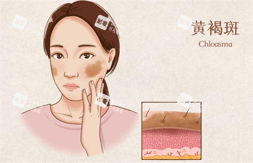 祛斑卡通图片展示