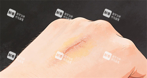 手部疤痕修复改善卡通