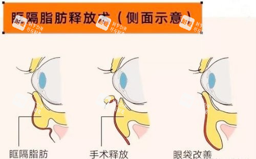 眶隔脂肪祛眼袋图示