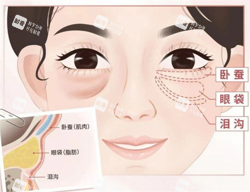 眼袋位置卡通图