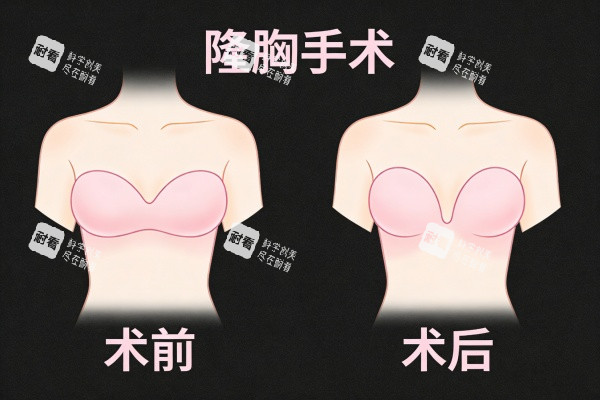 隆胸手术前后对比图