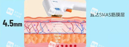 半岛超声炮炮头改善图