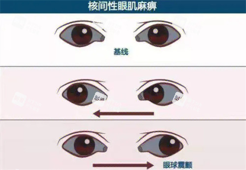 眼球震颤的样子 眼球震颤的样子