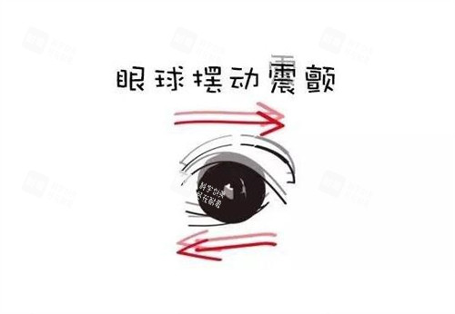 眼球震颤卡通图展示照片 眼球震颤卡通图展示照片