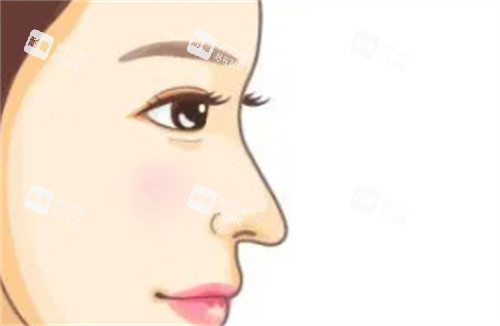 鹰钩鼻矫正示图 鹰钩鼻矫正示图