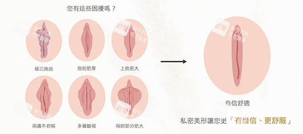 外阴阴唇整形前后变化