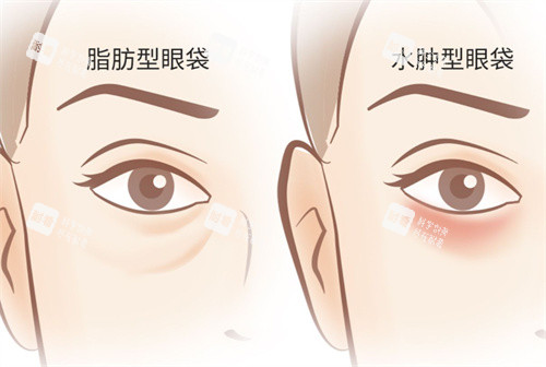 眼袋类型卡通图、 眼袋类型卡通图、