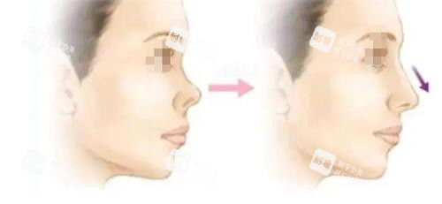 鼻翼缘后缩的症状