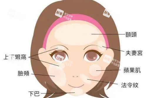 面部可以脂肪填充的部位卡通图