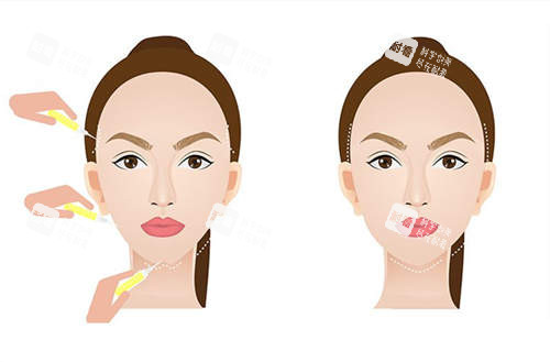 面部填充对比展示