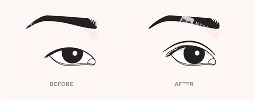 双眼皮手术前后对比 双眼皮手术前后对比