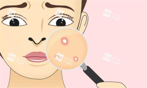 激光祛痘 激光祛痘