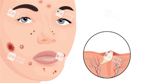 祛痘图片 祛痘图片