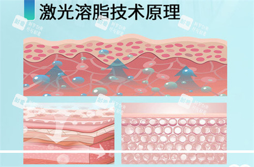 激光溶脂原理