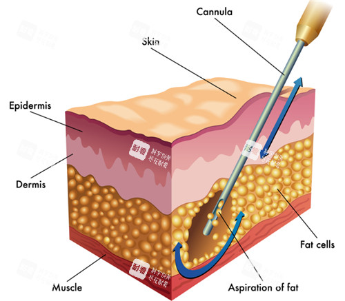 吸脂手术动画图示