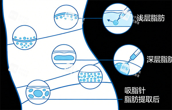 吸脂卡通图片通用