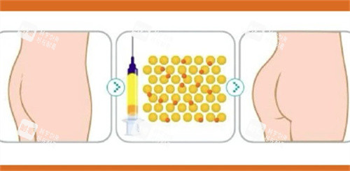 自体脂肪丰臀对比