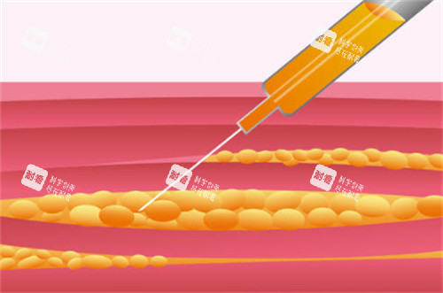 吸脂手术过程原理卡通图