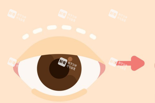 双眼皮手术卡通对比