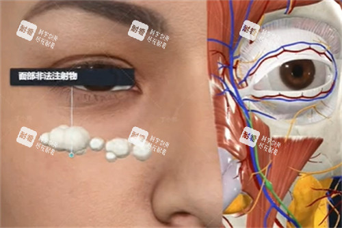 异物注射取出技巧