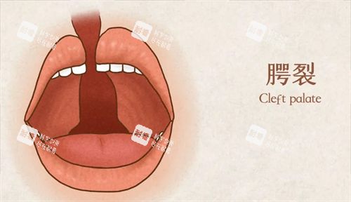 唇腭裂口内的动画展示