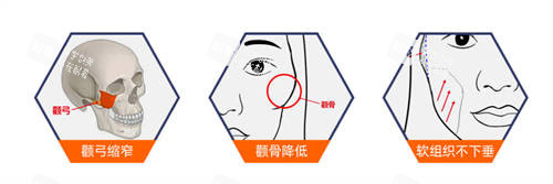 北京圣嘉新医疗美容医院张立天颧骨手术示意图