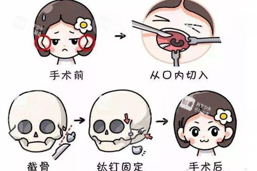 颧骨整形手术卡通形象图