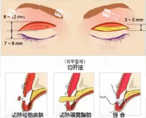 切开双眼皮手术