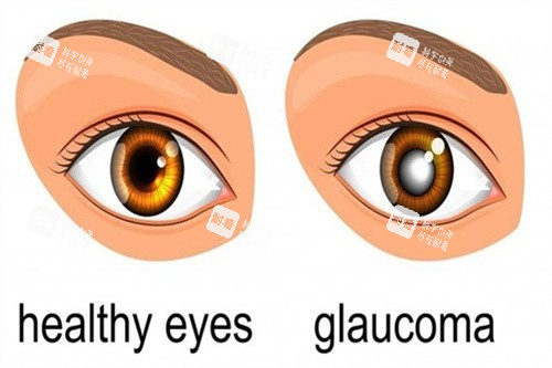 青光眼对比 青光眼对比