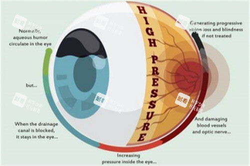 青光眼症状图片 青光眼症状图片