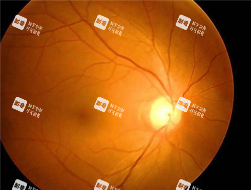 青光眼视力表现图
